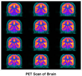 PET Scan of Brain